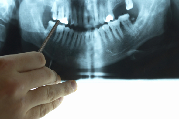 Röntgen beim Zahnarzt